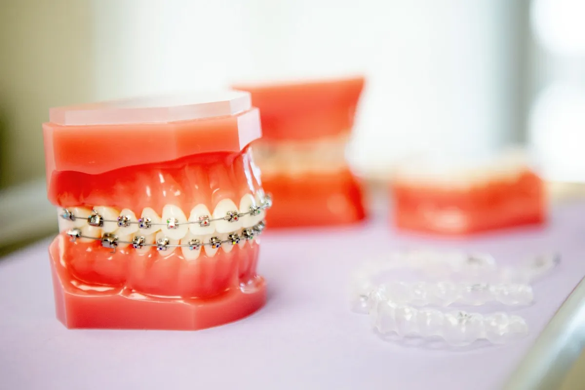 Dental model showing teeth with metal braces and clear aligners on a white surface.