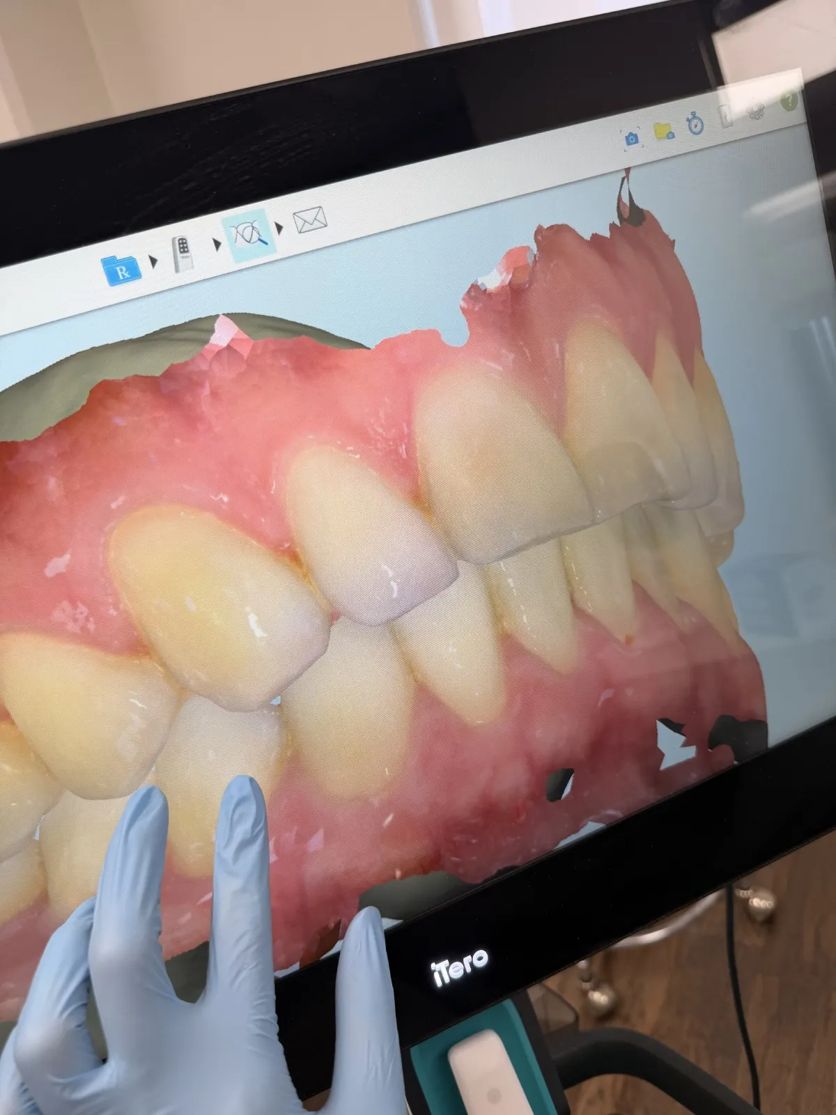 Close-up of a dental 3D scan of upper and lower teeth on an iTero screen with a gloved hand touching the device.