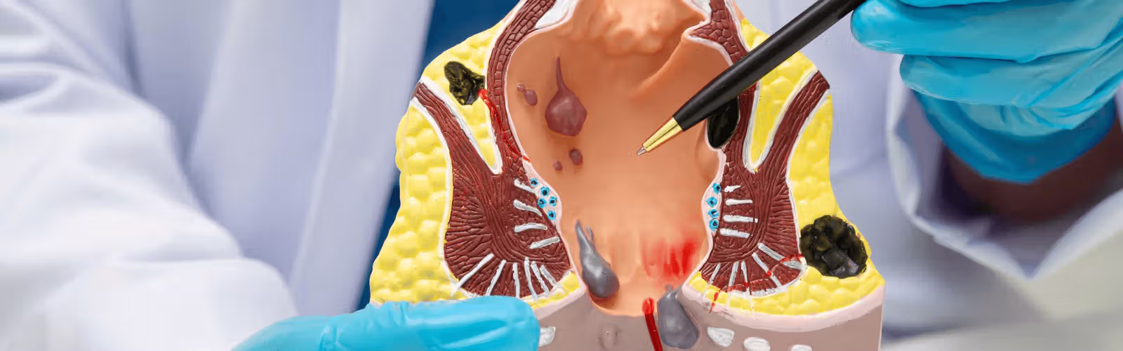 The best proctologist in Los Angeles points to a plastic model depicting hemorrhoids, showing internal and external hemorrhoids and inflammation, highlighting the best hemorrhoid treatment in Los Angeles.