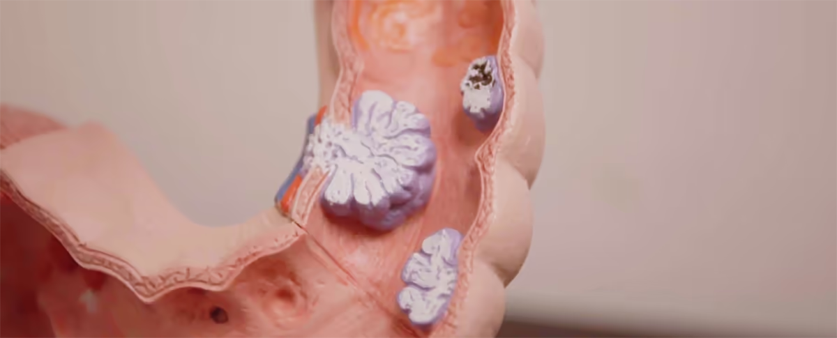 Graphic medical illustration of a human colon showing multiple colorectal polyps along the intestinal lining, used for patient education and screening awareness by the best colorectal surgeon in Los Angeles.