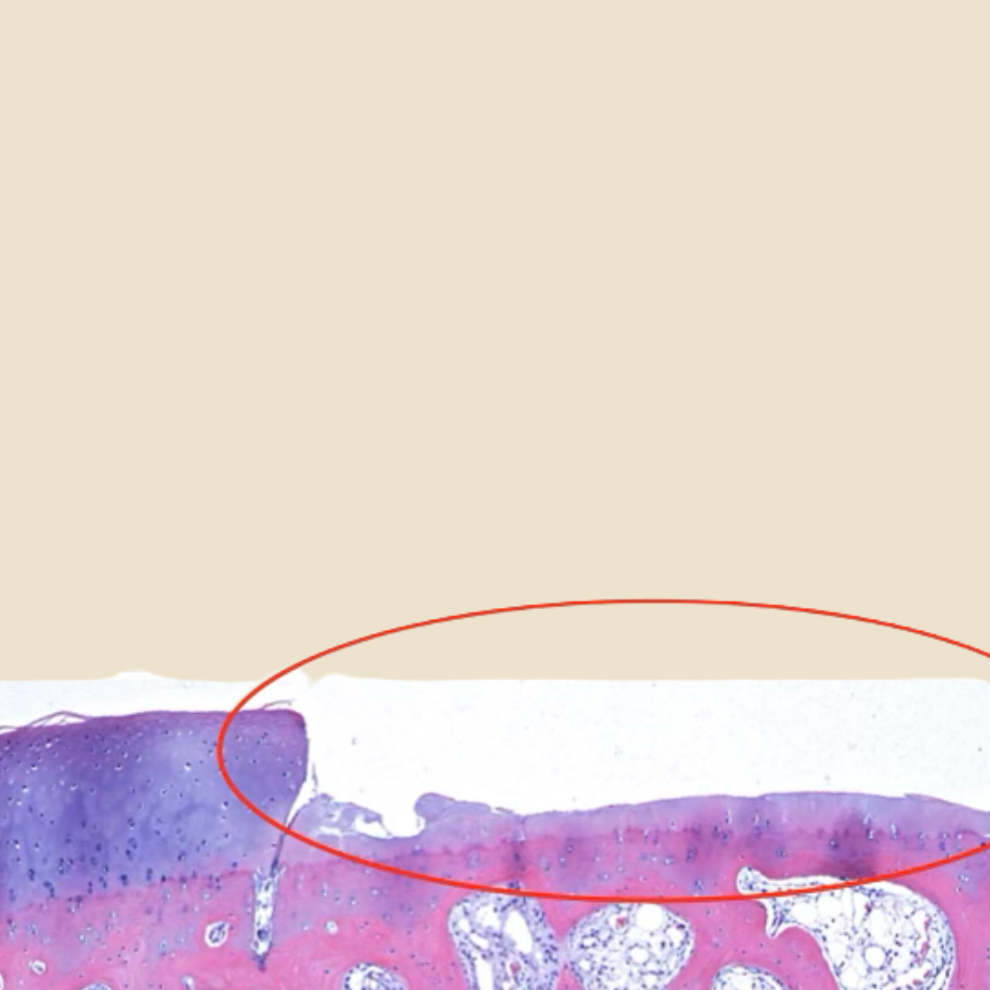 Arthroscopic view of the same joint twelve months after treatment, showing a smooth, repaired cartilage surface
