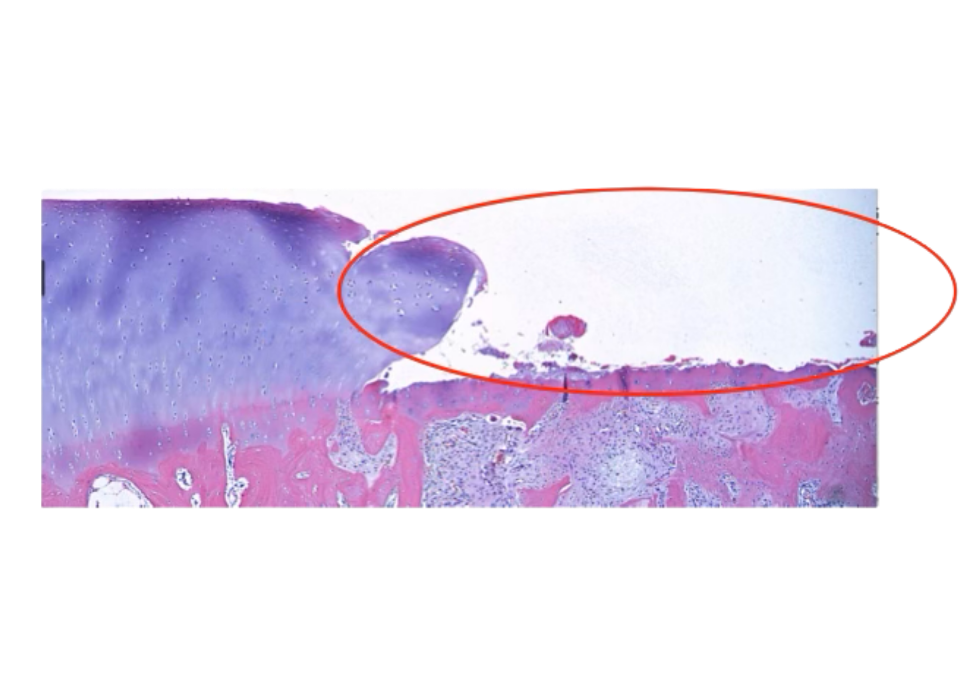 Tissue slide of a worn-down joint with a thin, inflamed cartilage cushion