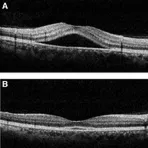 Two grayscale optical coherence tomography (OCT) cross-sectional scans of the retina labeled A and B showing detailed retinal layers.