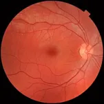 Close-up view of a human retina showing blood vessels and optic disc.