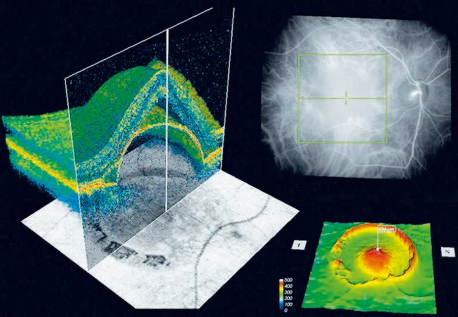 Medical imaging showing a 3D optical coherence tomography scan of an eye with cross-sectional and topographic views highlighting retinal structures.