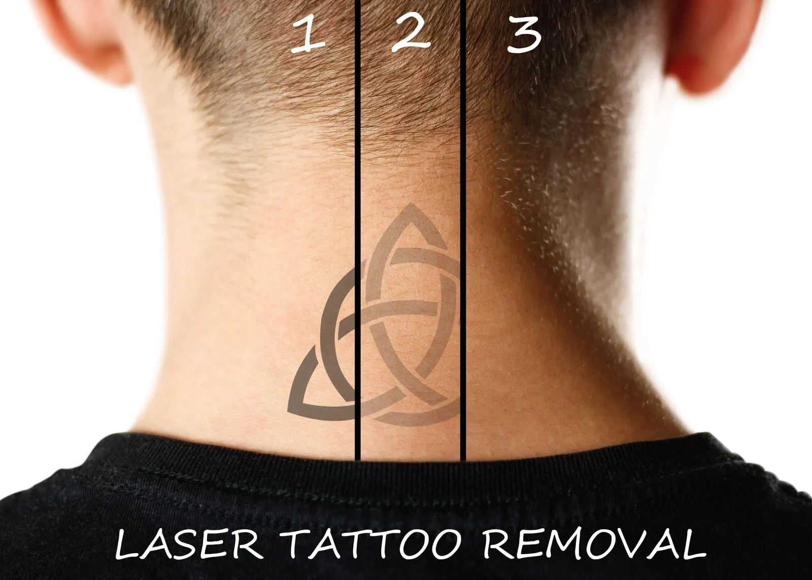 A man's tattoo showing different stages of removal
