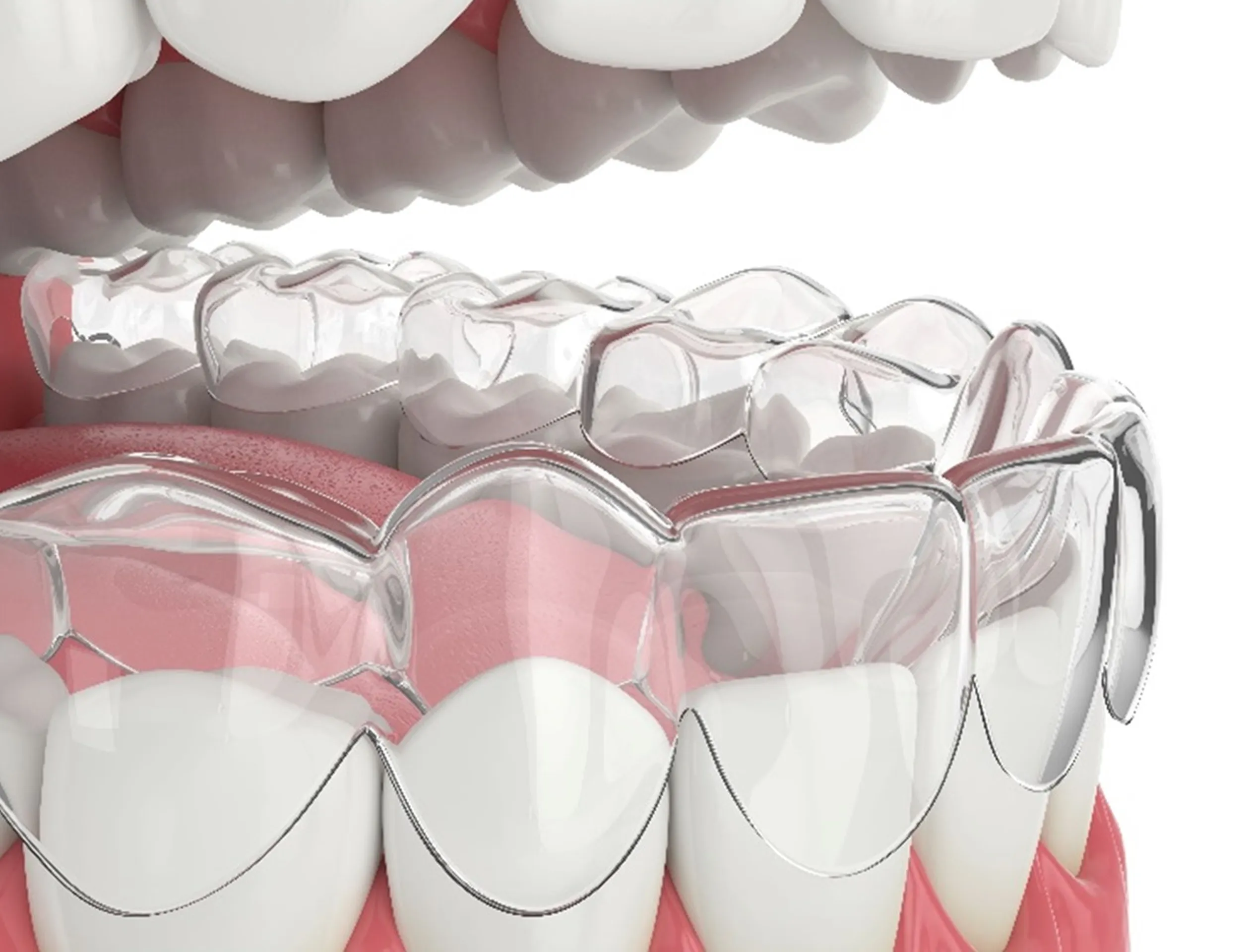 Clear dental aligner fitted over lower front teeth and gums.