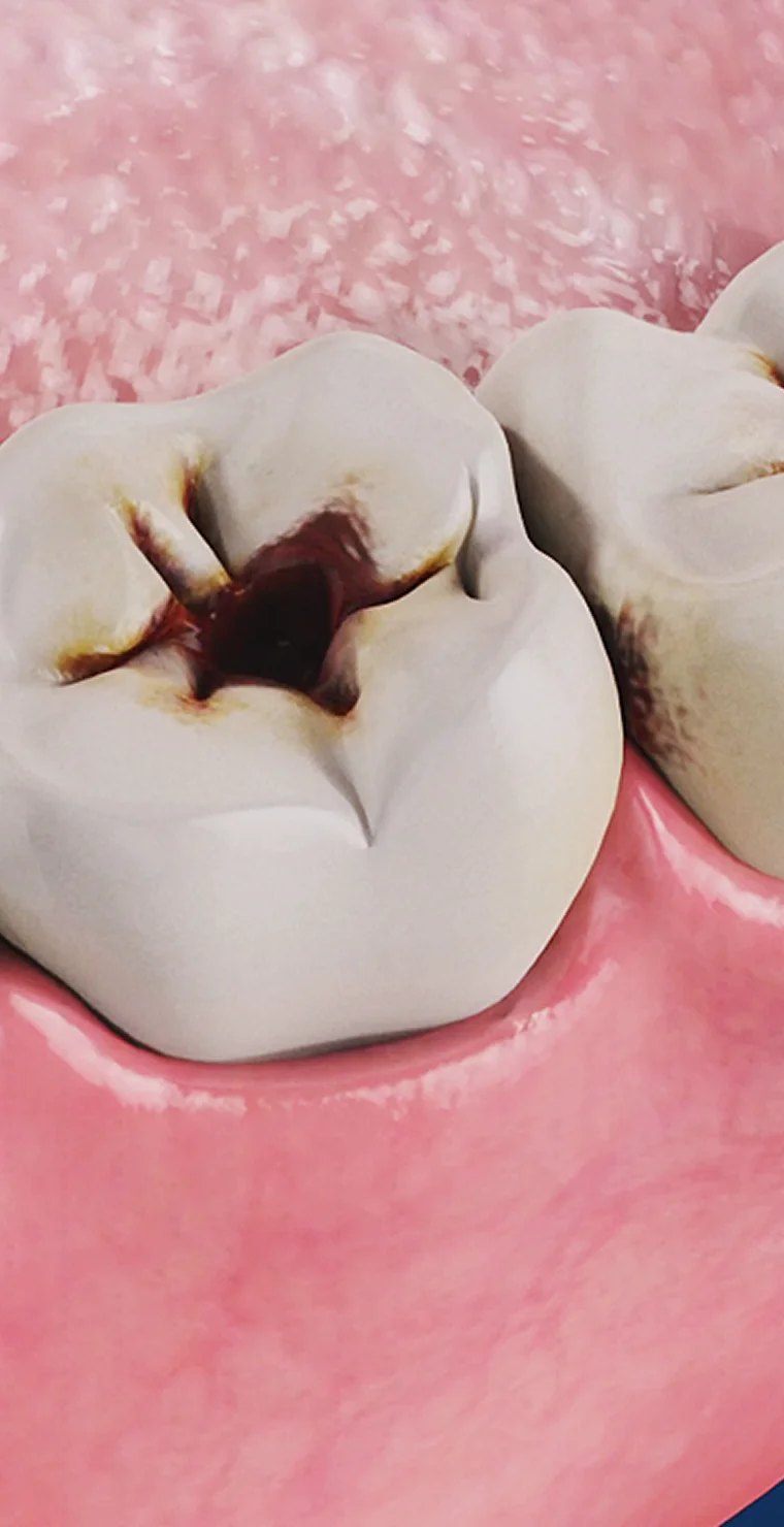 Лікування карієсу