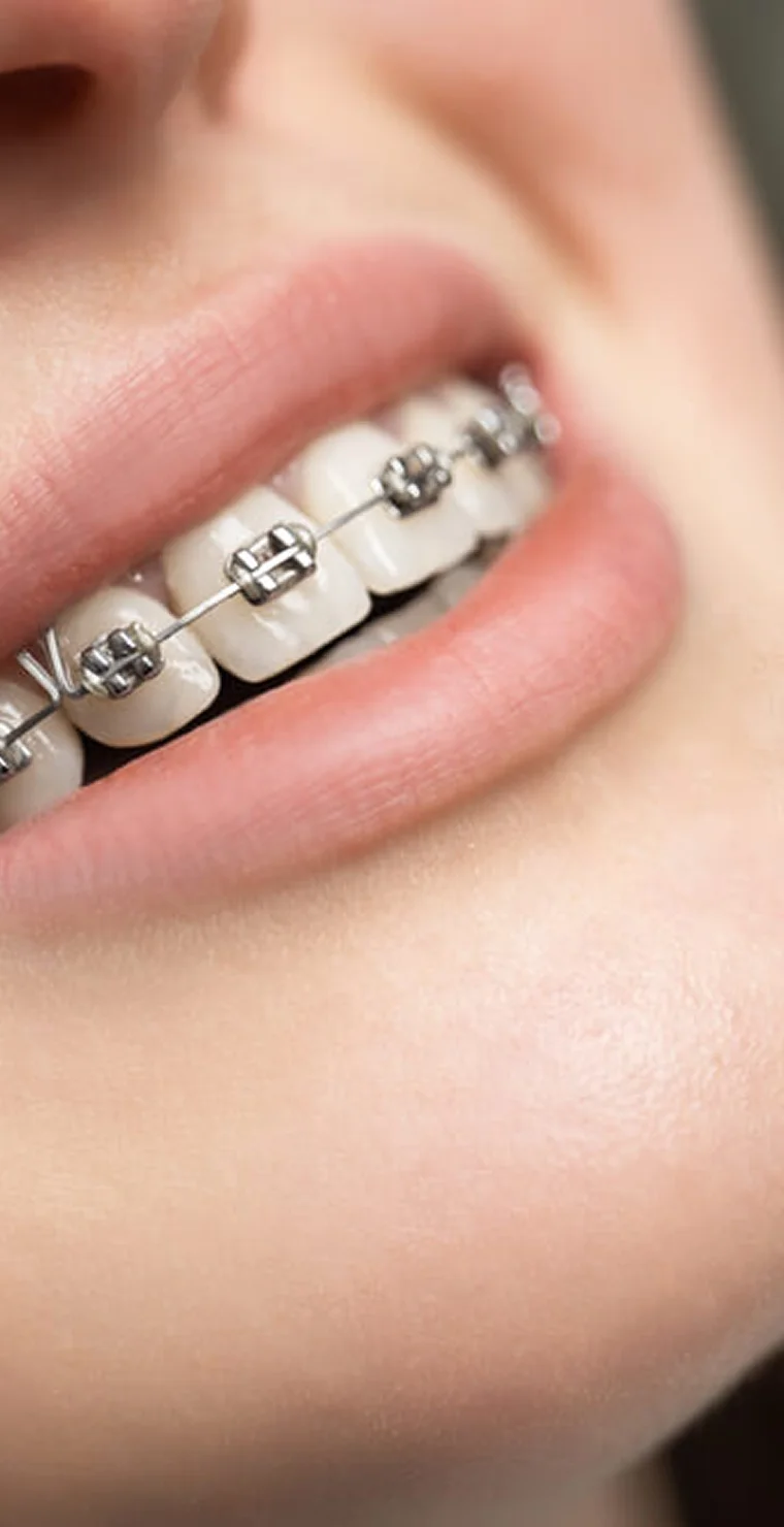 Преміум-брекети (США)