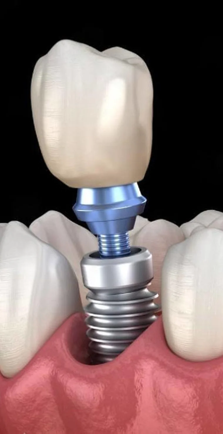 Імплант Alphabio (Ізраїль)