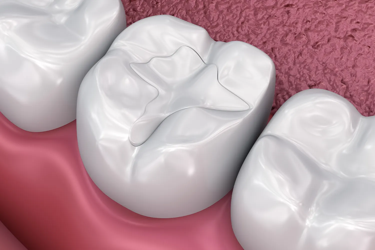Pediatric Dental Fillings in Parrish, FL | Sweet Street