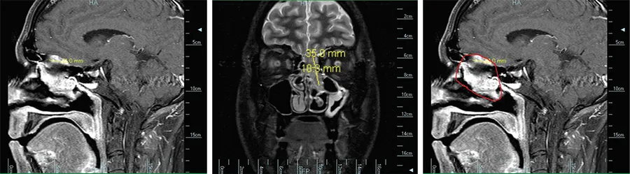 MRI brain with red circled lesion