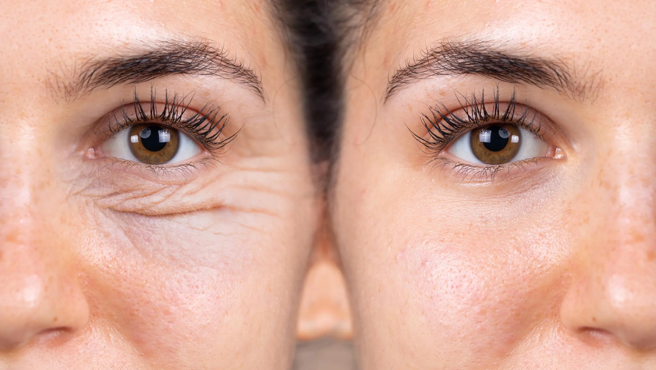 Close-up comparison of two brown eyes showing under-eye wrinkles on the left side and smooth skin on the right side.