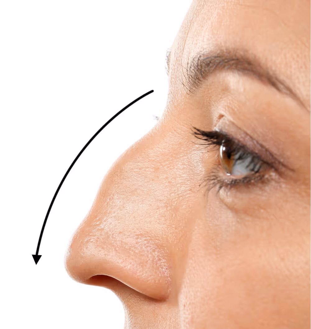 Close-up side profile of a woman's nose with an arrow indicating downward contour.