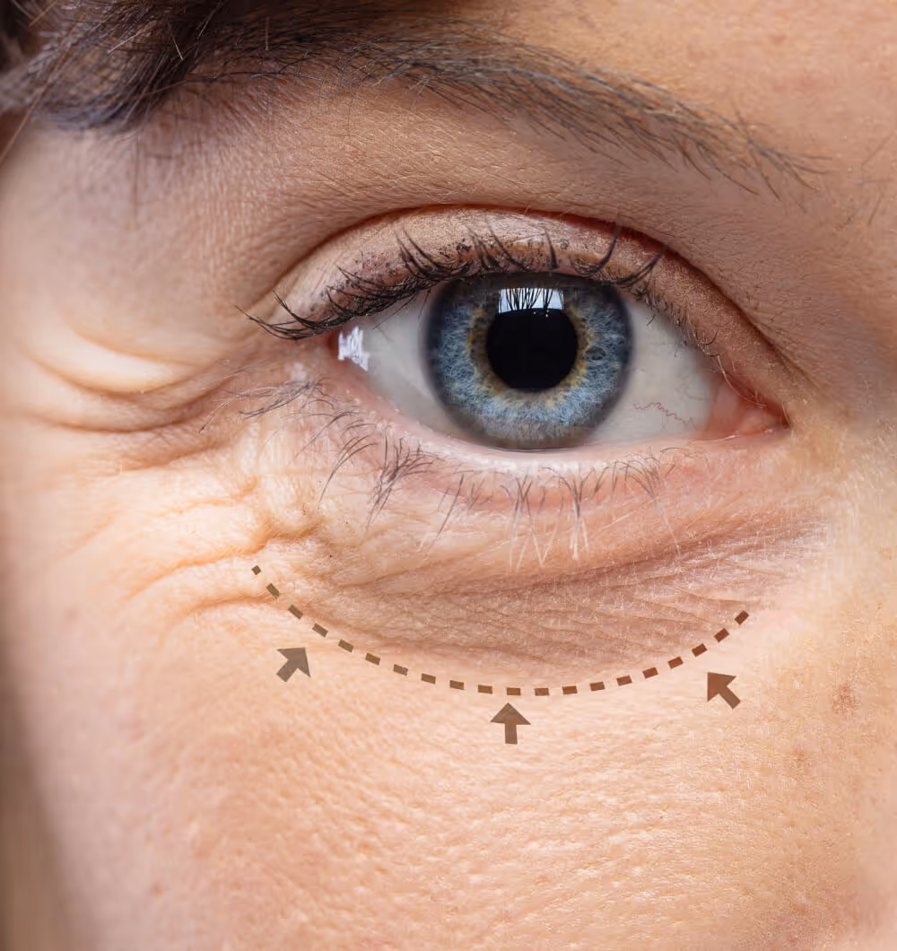 Close-up of a blue eye with wrinkles under the eye, highlighted by a dotted line and arrows indicating the area.