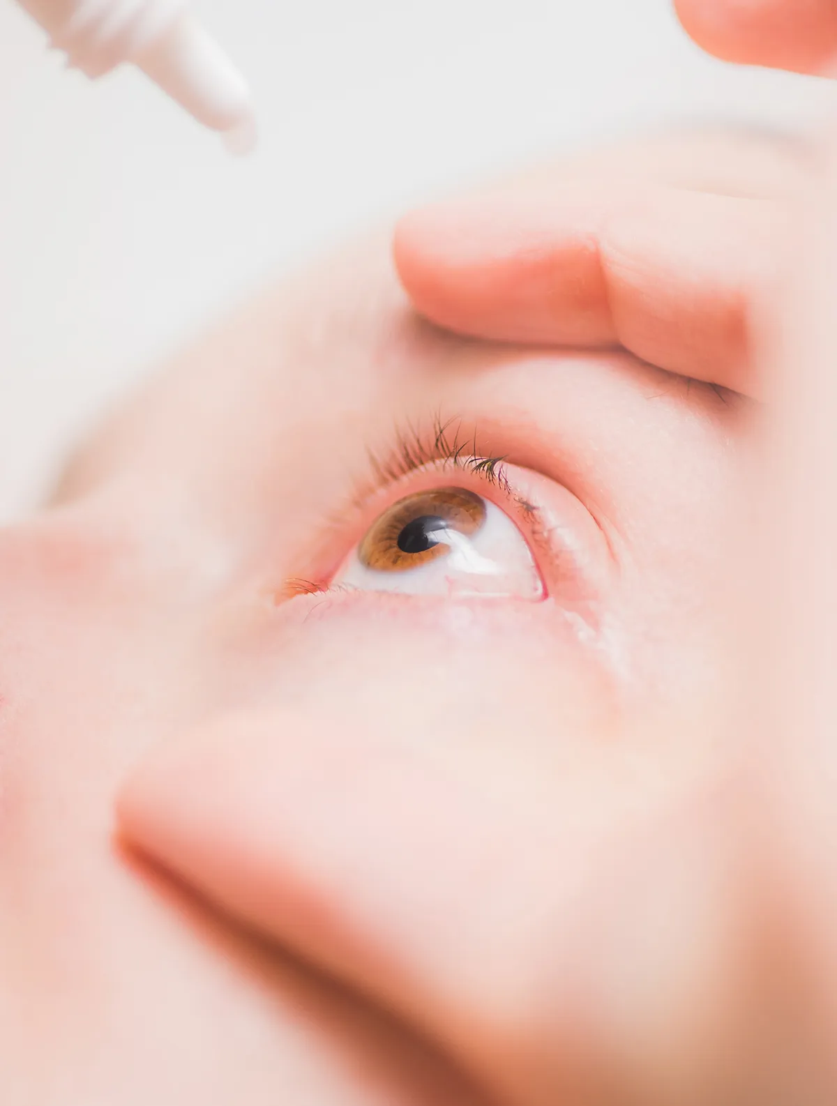 Close-up of a person applying eye drops to their open eye while holding the eyelid.
