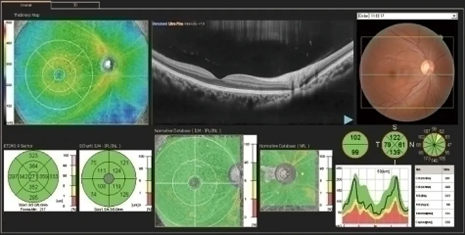 Comprehensive OCT scan analysis displaying retinal layers and optic nerve health assessment