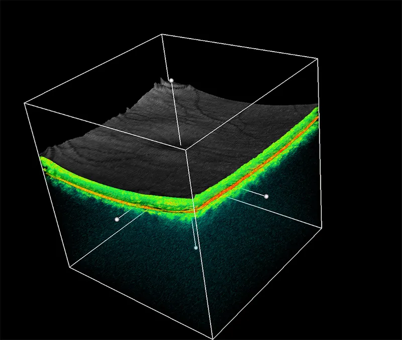 3D OCT scan image of the retina showing layered structures in color-coded detail inside a transparent cube.