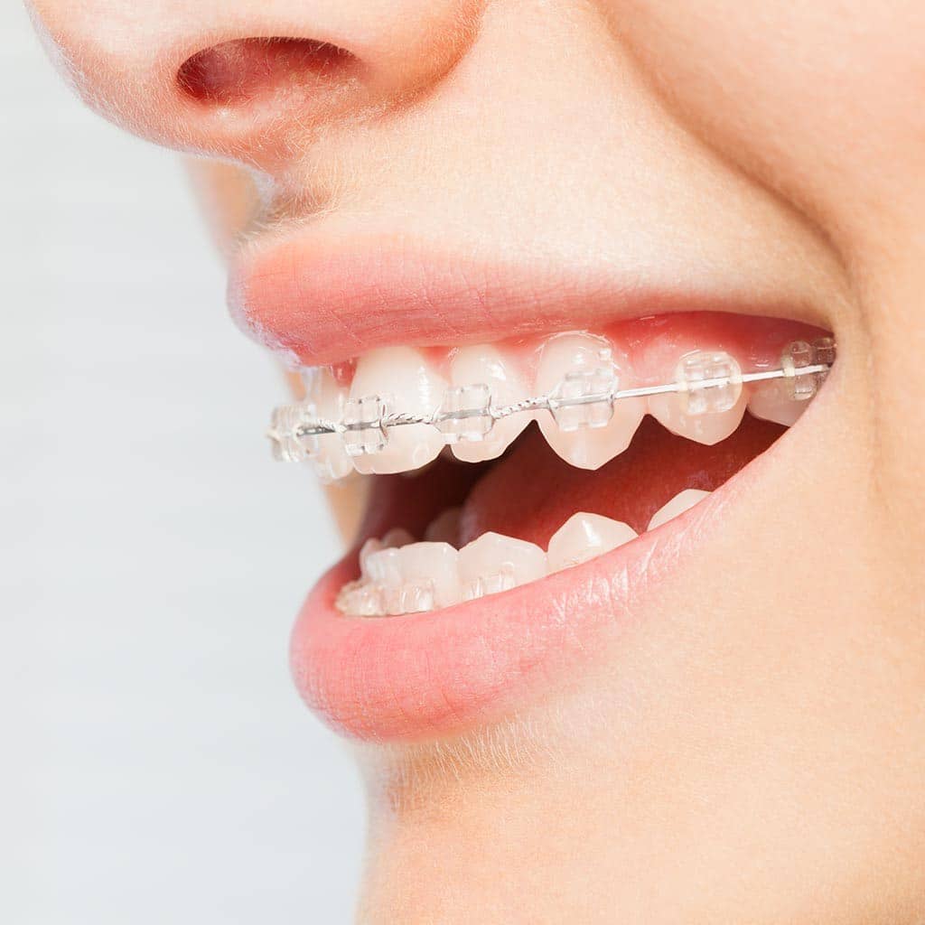 Clear Ceramic Braces | Discreet Orthodontics at Speaker Smiles