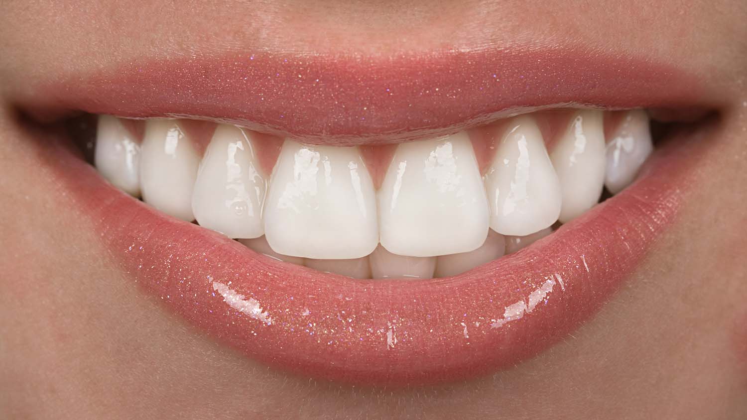 Do You Need to Shave Your Teeth for Veneers?