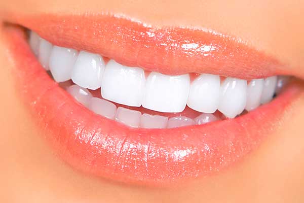 How Can I Keep My Veneers in Good Shape? - Dental Resort
