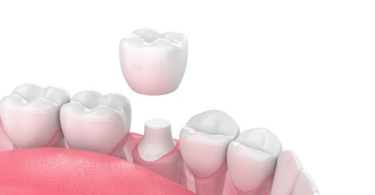 How Long Does a Temporary Crown Last? - Find Local Dentists