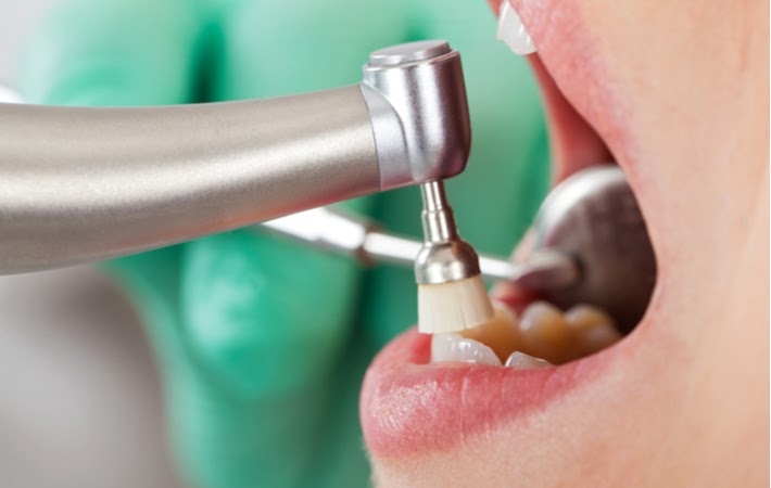 Teeth Cleaning: How Long Do They Last & What to Expect