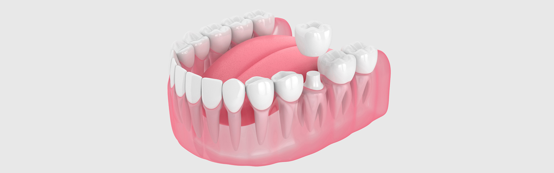 Is it Painful to Get a Crown? Exploring the Truth Behind Dental Caps