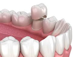 Dental Crowns Service in Covington, GA | Expert Crowns Dentist