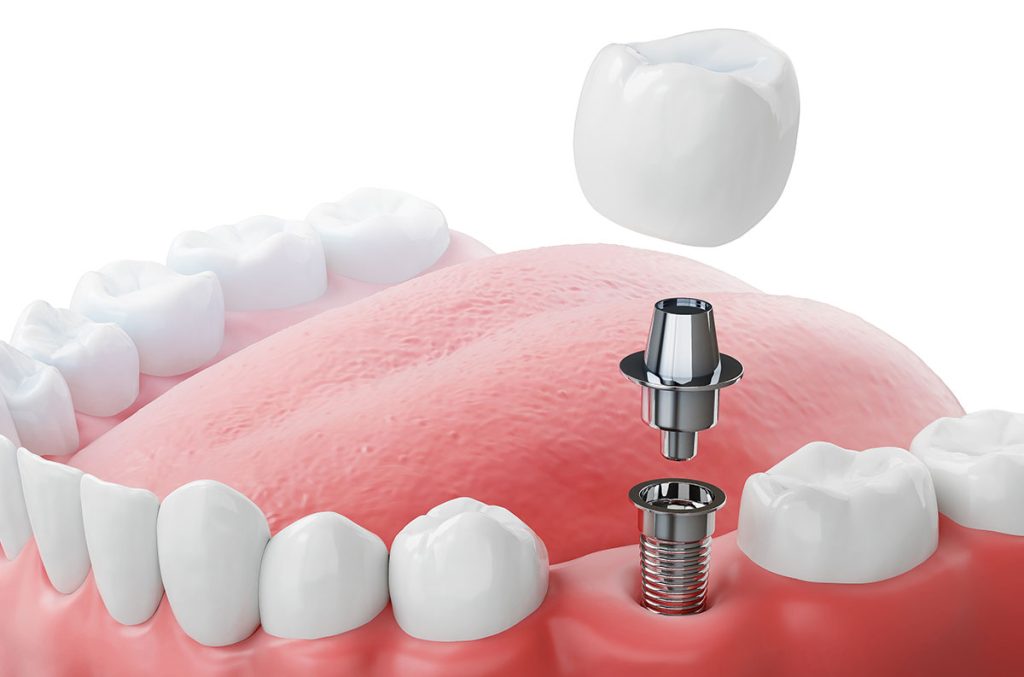 What Should You Know Before Getting a Dental Implant?