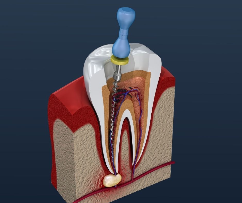 Everything You Need to Know About Root Canals - Premier Dental Center  Bulverde