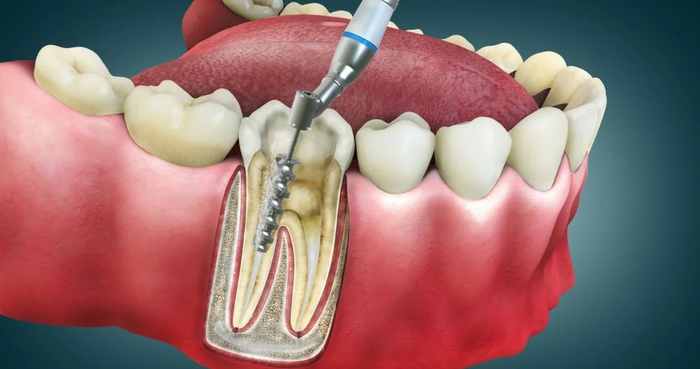 What is a Root Canal? - Root canal treatment & side effects