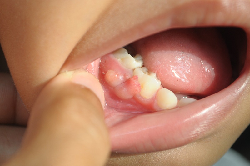 Gum Boil: Causes, Pictures and How to Treat a Gum Boil?