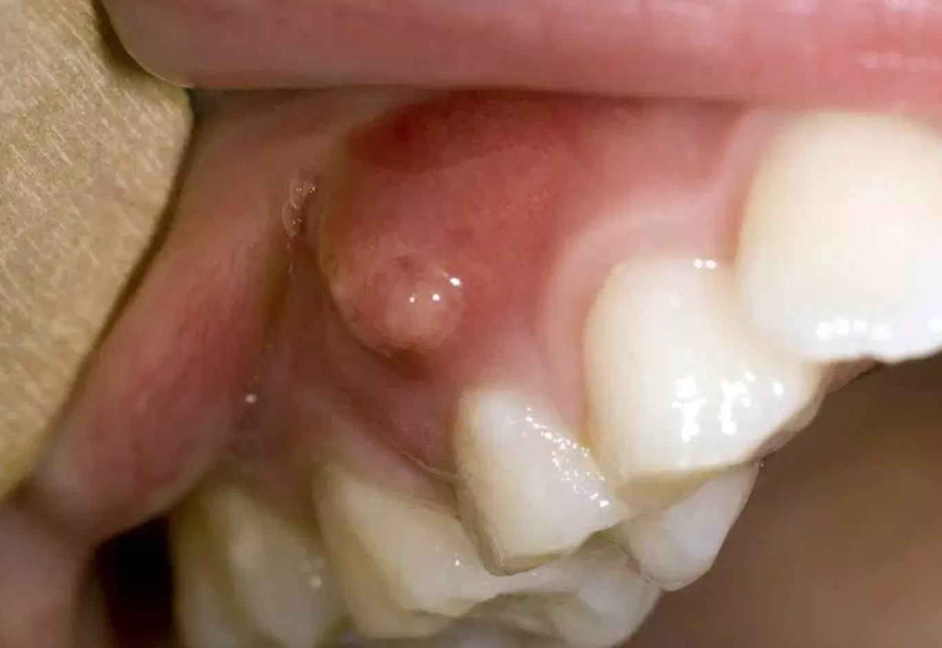 Dental Abscess:Causes, Symptoms & Treatments- French Dental Services  -Dr.Miski