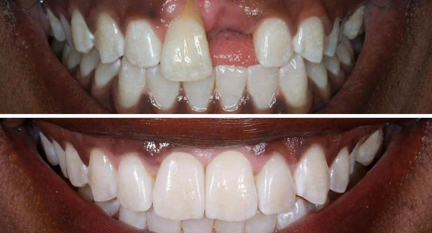 Achieving A Perfect Smile: Can Veneers Help With Missing Teeth?