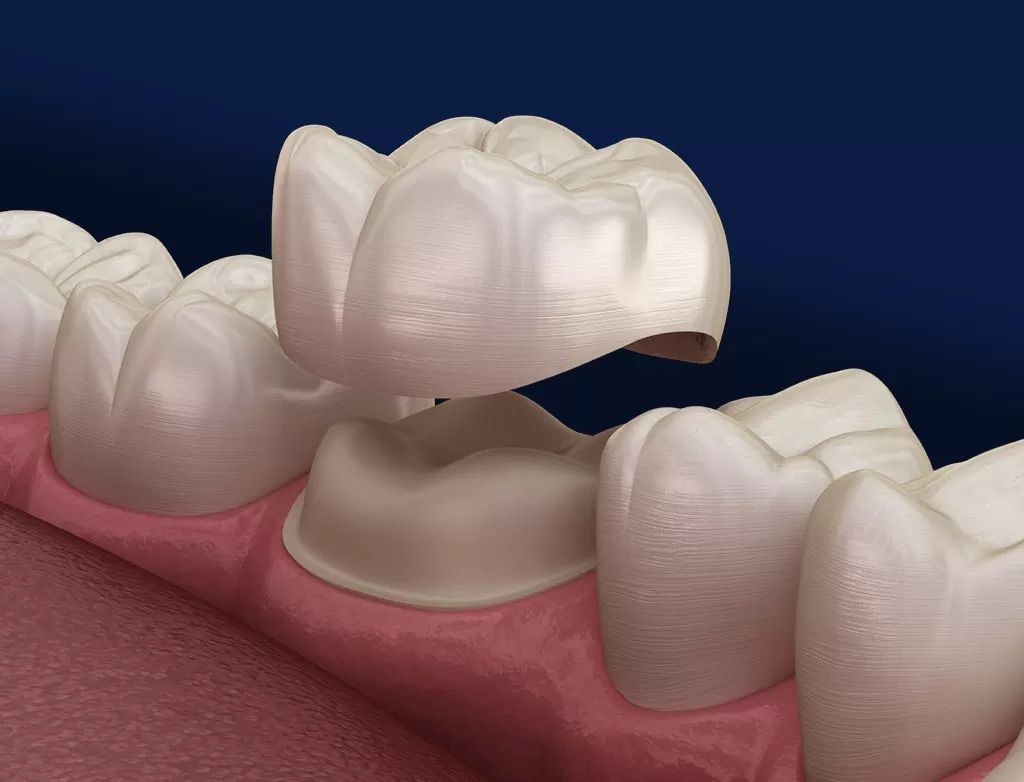 Everything You Need to Know About Dental Crowns | Weston, FL