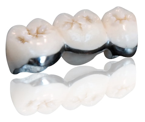Porcelain Fused to Metal | Continental Dental Laboratories | Services