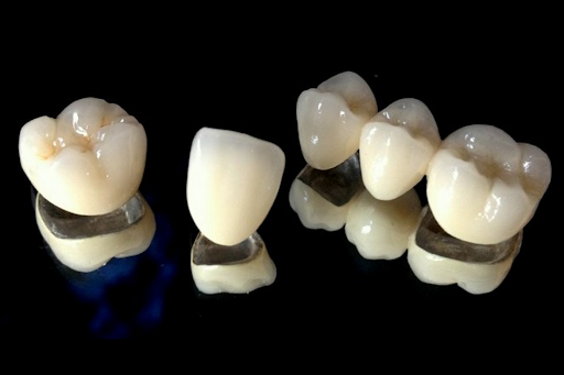Porcelain-Fused-To-Metal (PFM) Crown And Bridge ~ Dr. Bharat Katarmal Dental  & Implant Clinic