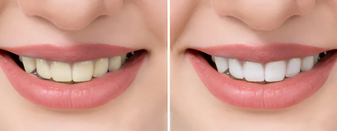Does a Scale and Polish Whiten Your Teeth
