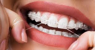 Flossing with Braces – How to Floss When you Have Braces | The Orthodontists