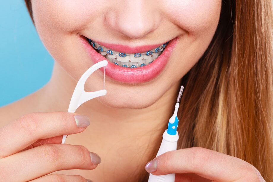 How to Floss Your Teeth With Braces | Tender Smiles in NJ
