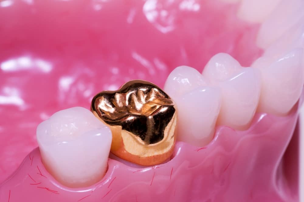 Permanent Gold Tooth | Does It Damage Your Natural Tooth?