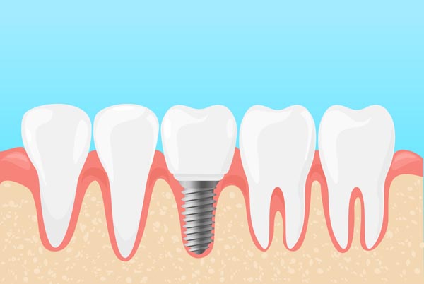 Is It Better to Save Your Tooth or Get a Dental Implant? | Preferred Dental  Center