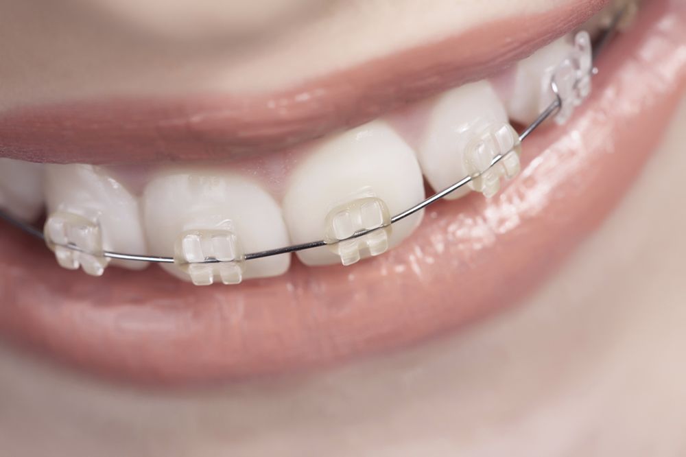 What Is the Best Age to Get Braces? - Philadelphia, PA - Bala Cynwyd, PA -  Bensalem, PA