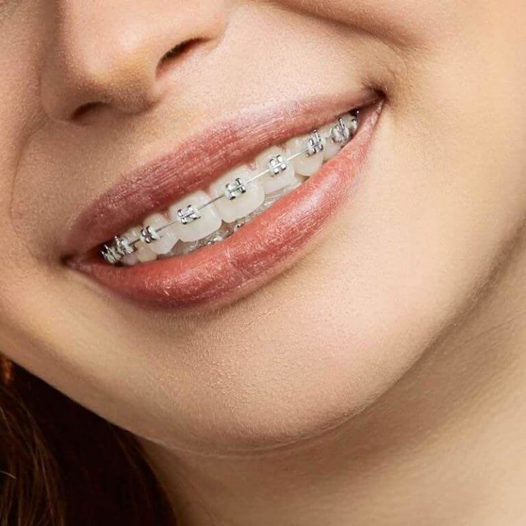 Ceramic Braces vs Metal Braces — Which Works Best for You?