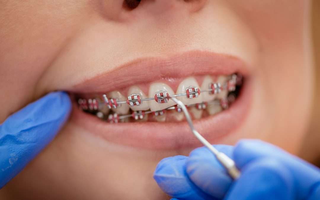 How Long Do Braces Take To Work? | Heroes Dental