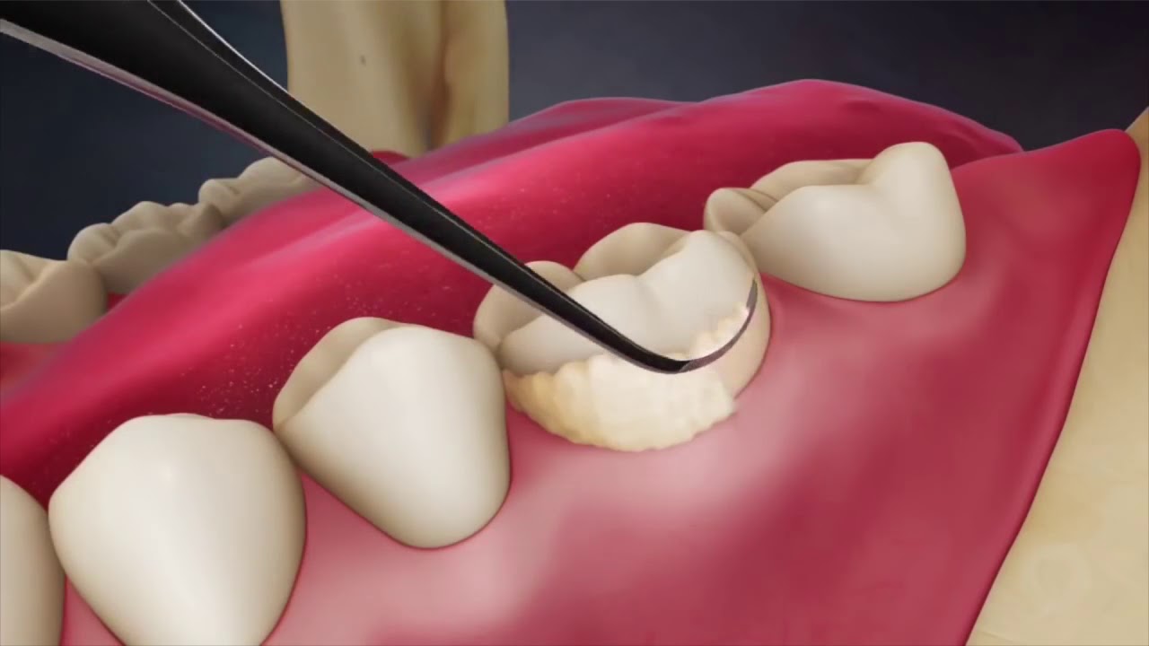 Dental Scaling: Know the procedures? - YouTube