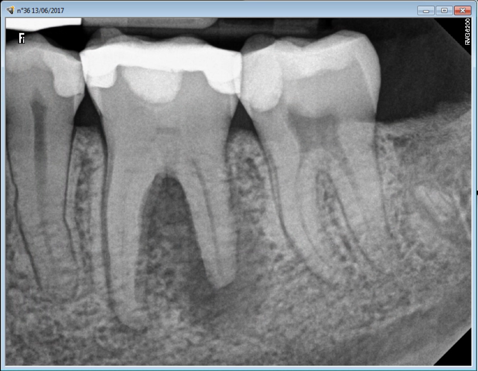 Saving a Severely Calcified Tooth with a Root Canal Procedure | ENDOMONTREAL