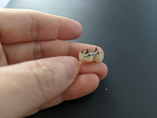 My Crown Fell Out, What Should I Do? - afterva - Oral Health Library