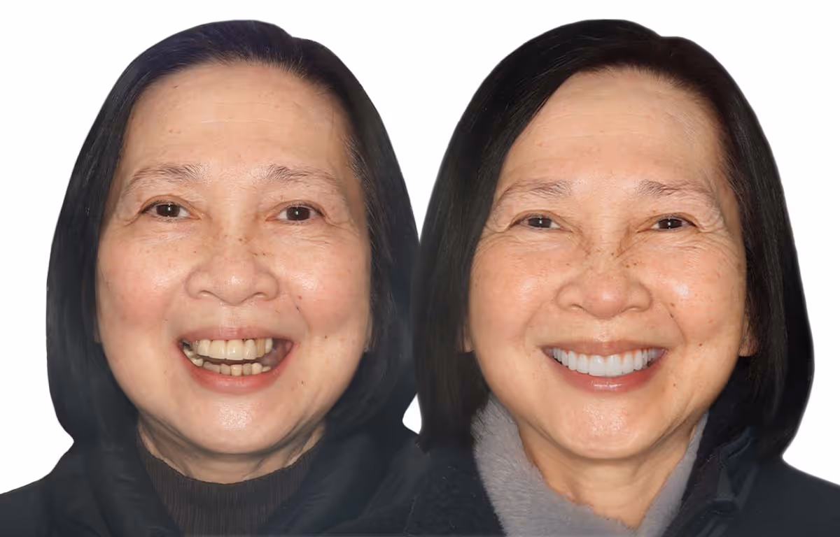 Side-by-side comparison of an elderly woman smiling, showing before and after dental improvement with whiter, aligned teeth on the right.